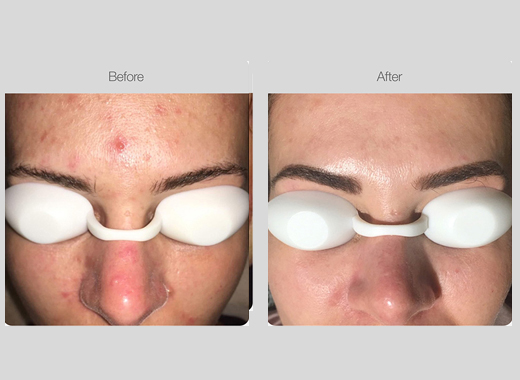 IPL Acne Management