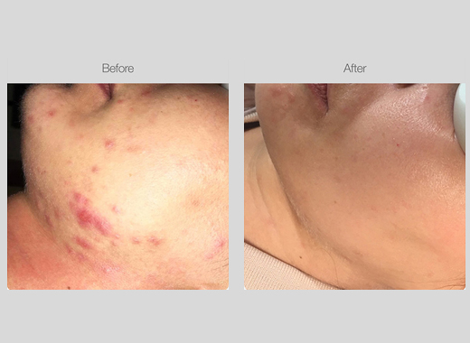 IPL Acne Management