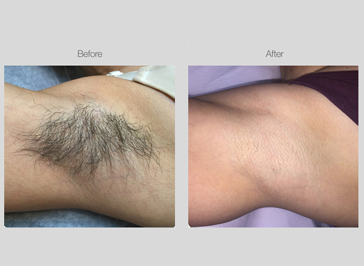 IPL Hair Removal