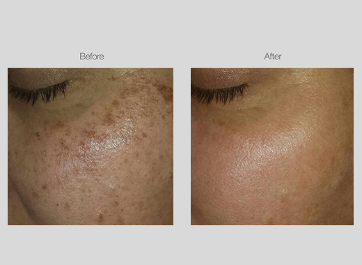 IPL Pigmentation