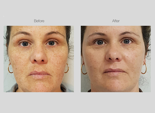 IPL Pigmentation