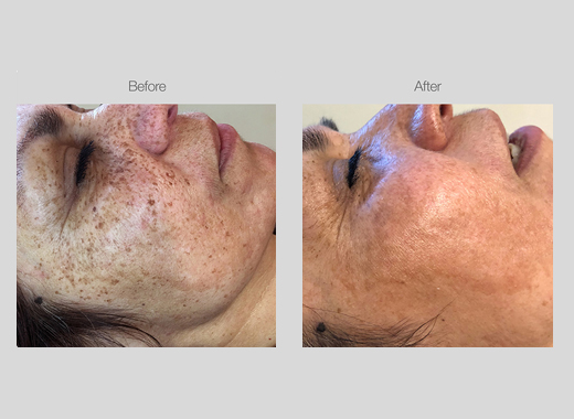 IPL Pigmentation