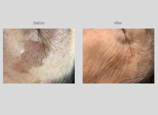 IPL Pigmentation