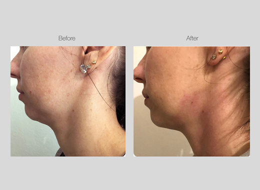 RF Skin Tightening