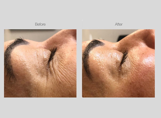 RF Skin Tightening