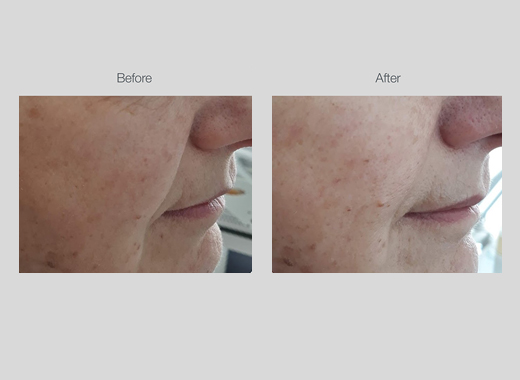 RF Skin Tightening