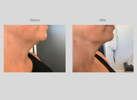 RF Skin Tightening