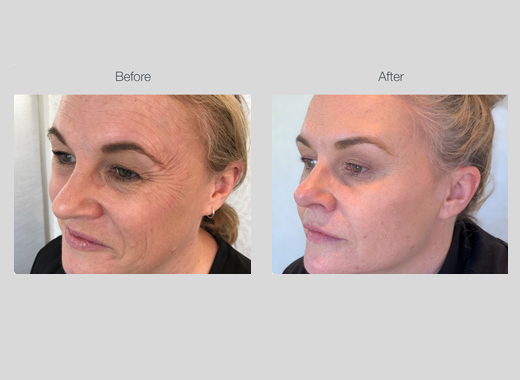 RF Skin Tightening