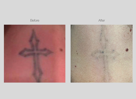 Tattoo Removal