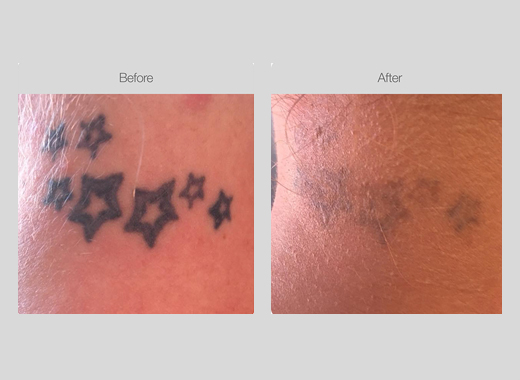 Tattoo Removal