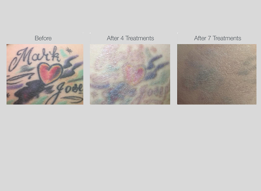 Tattoo Removal