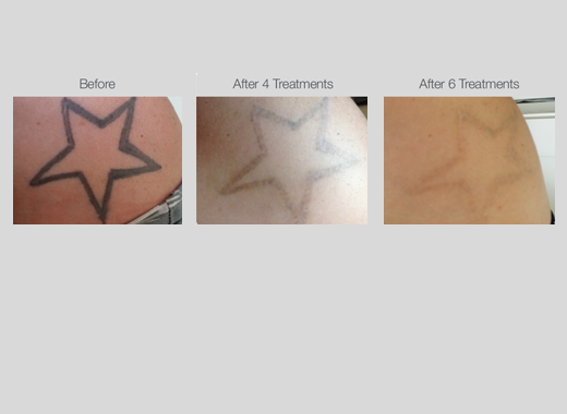 Tattoo Removal