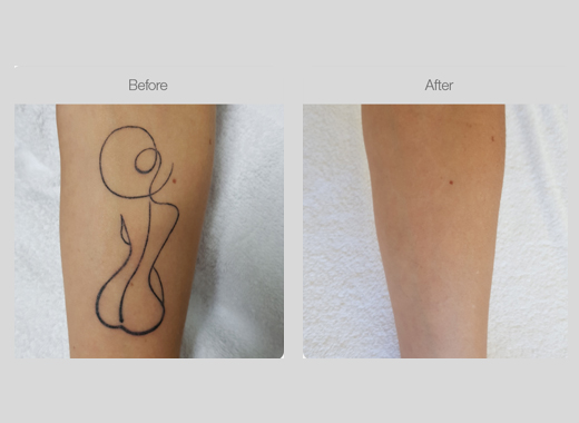 Tattoo Removal