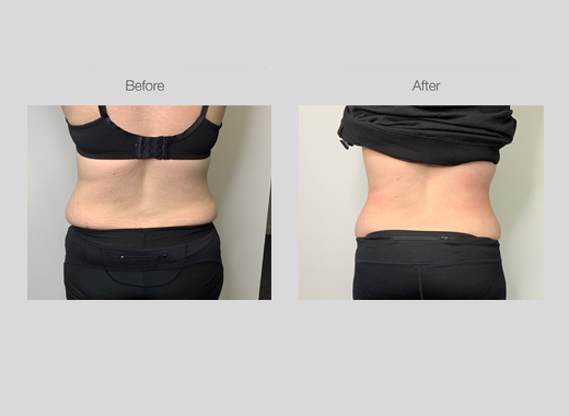 Ultrasound Body Contouring