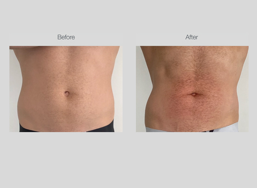 Ultrasound Body Contouring