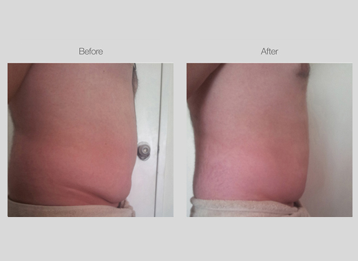 Ultrasound Body Contouring