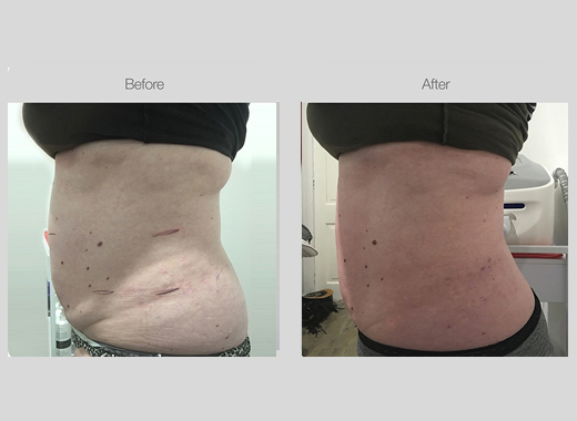 Ultrasound Body Contouring