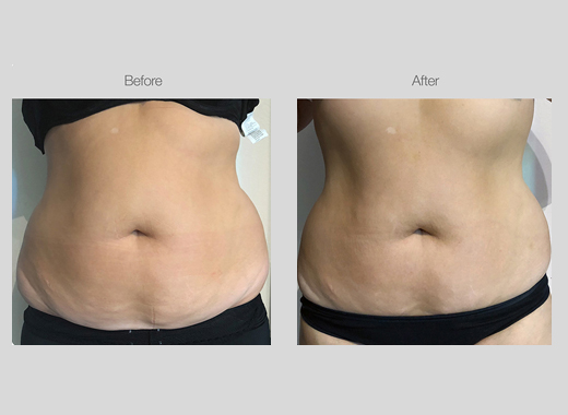 Ultrasound Body Contouring