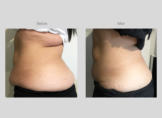 Ultrasound Body Contouring