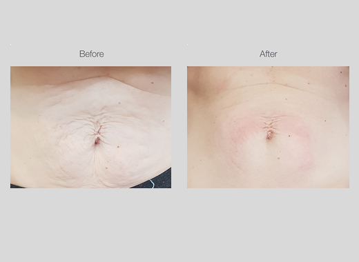 Ultrasound Body Contouring